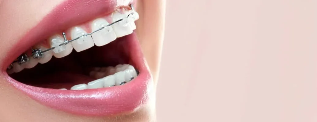 Smile Engineering: How Braces are Tailored for Individual Dental Needs