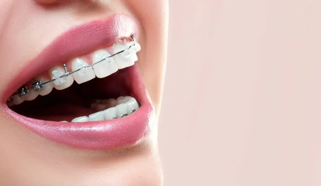 Smile Engineering: How Braces are Tailored for Individual Dental Needs