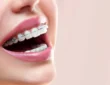 Smile Engineering: How Braces are Tailored for Individual Dental Needs