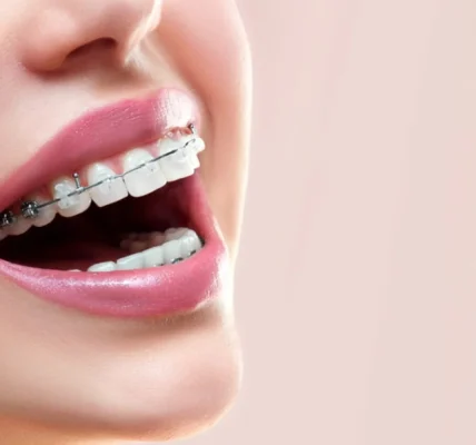 Smile Engineering: How Braces are Tailored for Individual Dental Needs