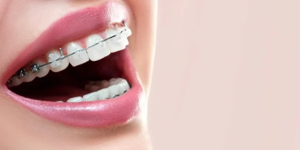 Smile Engineering: How Braces are Tailored for Individual Dental Needs