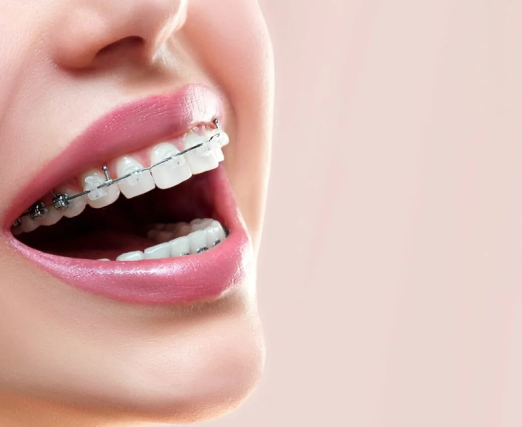 Smile Engineering: How Braces are Tailored for Individual Dental Needs