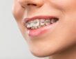 Understanding Orthodontic Relapse and Why Teeth Shift After Treatment Ends