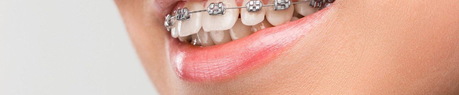 Understanding Orthodontic Relapse and Why Teeth Shift After Treatment Ends