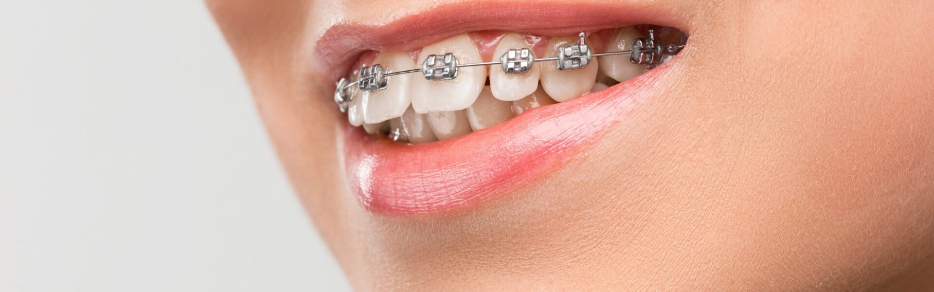 Understanding Orthodontic Relapse and Why Teeth Shift After Treatment Ends