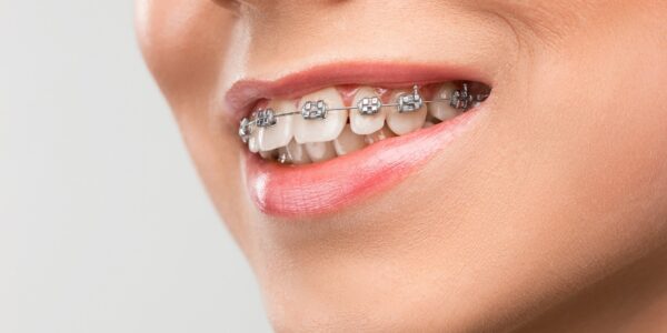 Understanding Orthodontic Relapse and Why Teeth Shift After Treatment Ends