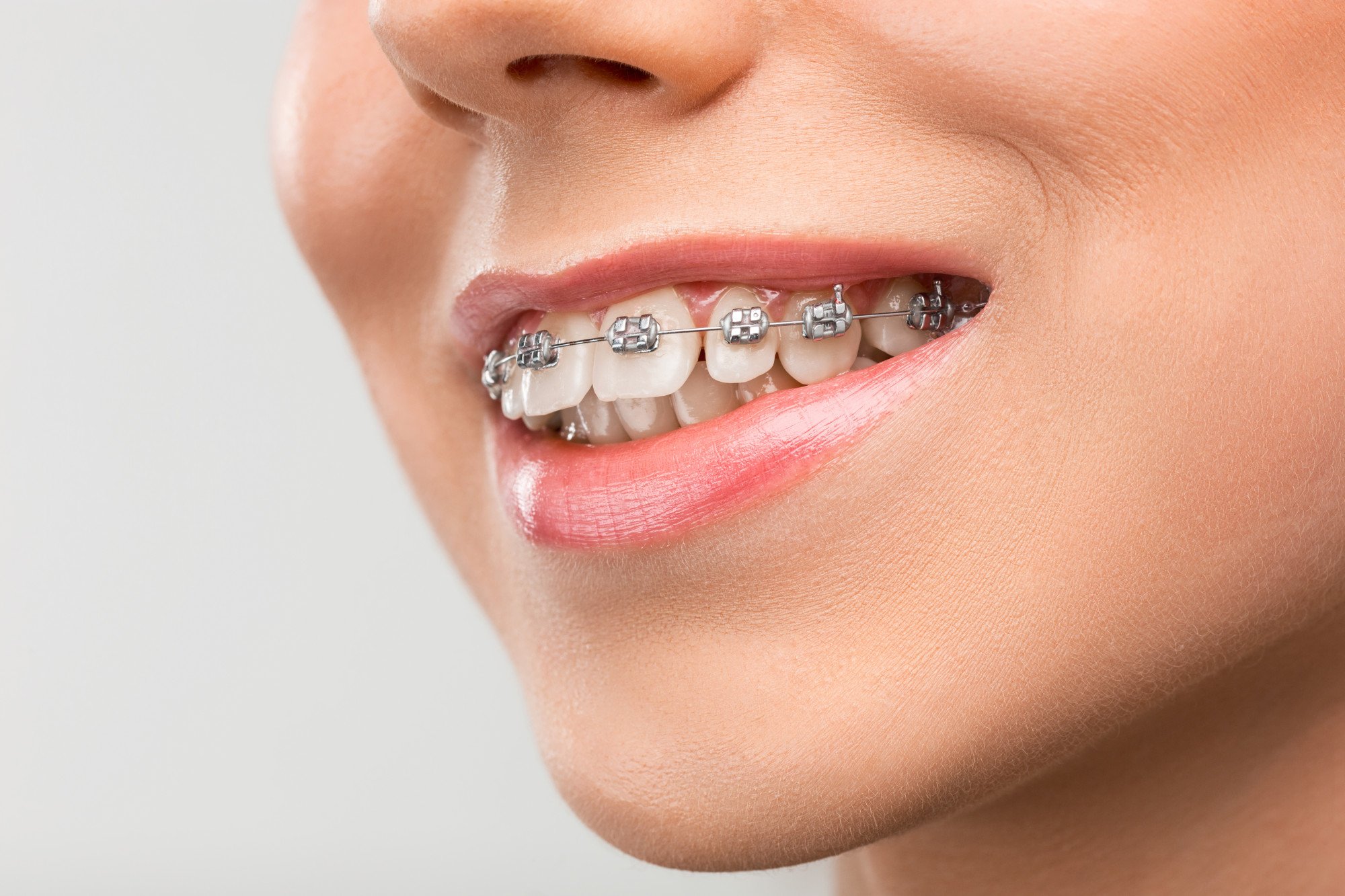 Understanding Orthodontic Relapse and Why Teeth Shift After Treatment Ends